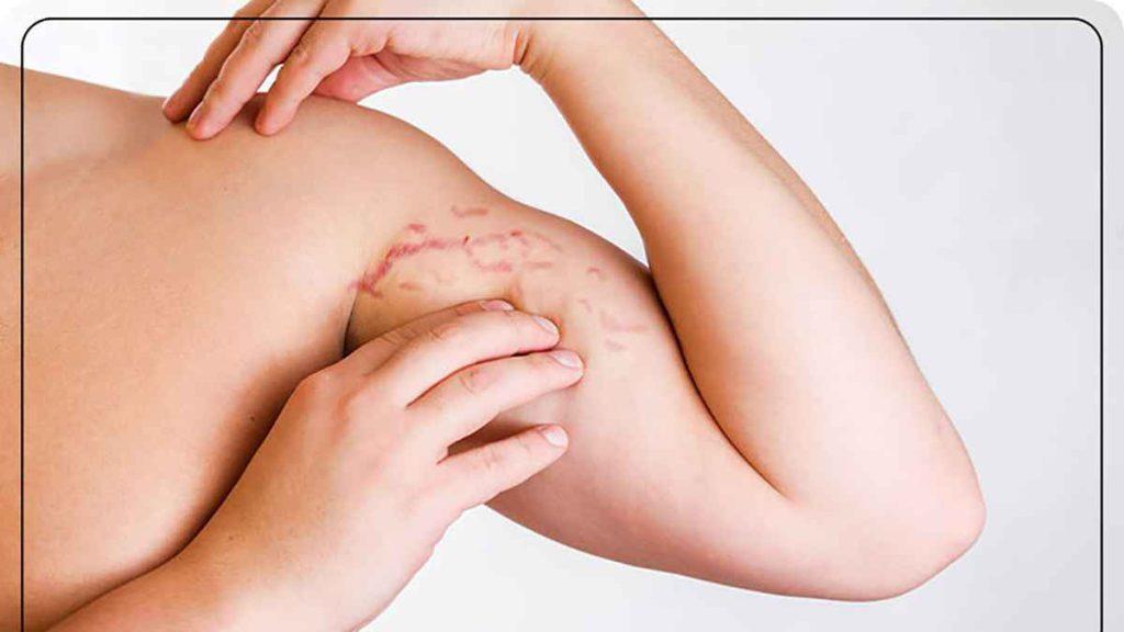 درمان ترک پوستی بدنسازی