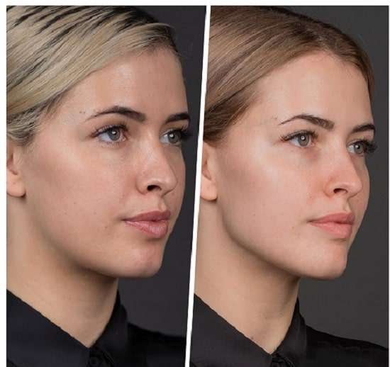 تزریق ژل گونه|مزایا و عوارض آن-https://dermatologyclinic.ir
