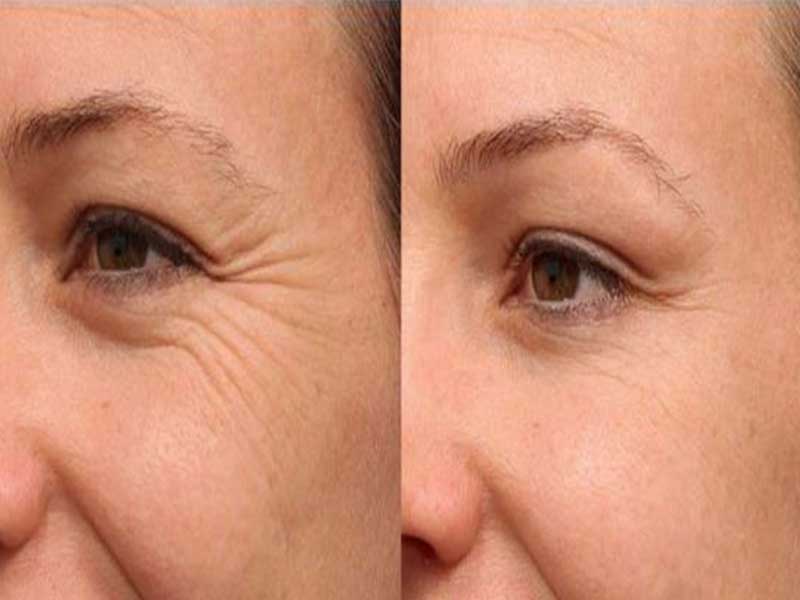 تزریق فیلرزیرچشم-https://dermatologyclinic.ir