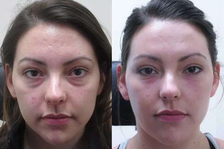 عوارض جانبی فیلرهای صورت-https://dermatologyclinic.ir