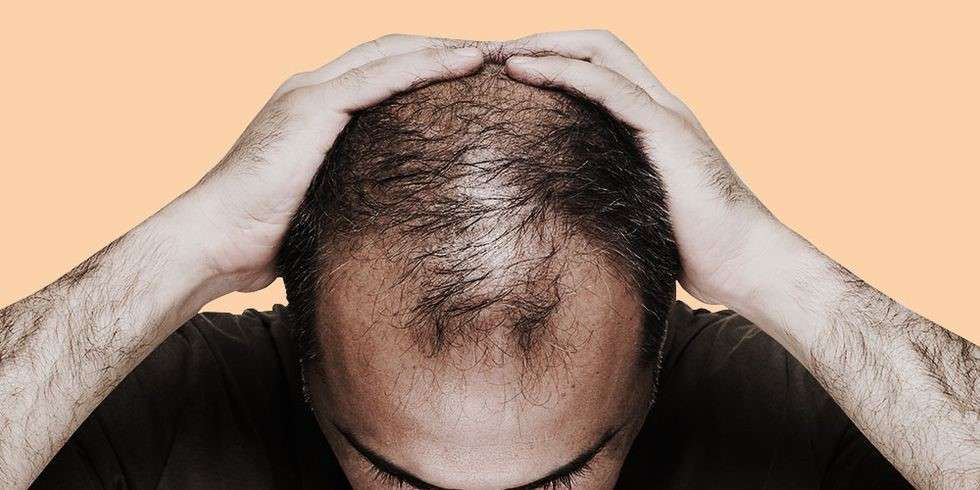 الگوی ریزش مو سر مردانه