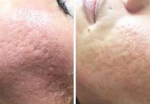 قبل و بعدد مزوتراپی جای آکنه