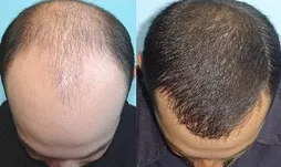 قبل و بعد مزوتراپی مو