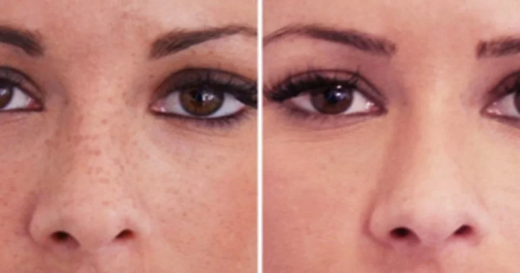 چگونه می‌توانیم از عفونت پس از درمان با لیزر کیوسوئیچ مدلایت جلوگیری کنیم؟-https://dermatologyclinic.ir