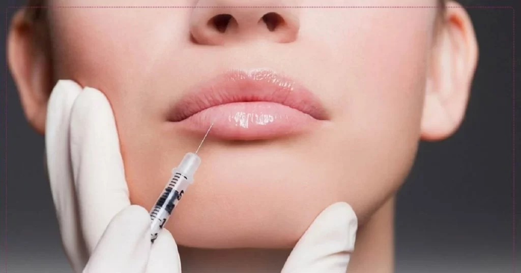ماندگاری فیلر لب چقدر است؟-https://dermatologyclinic.ir