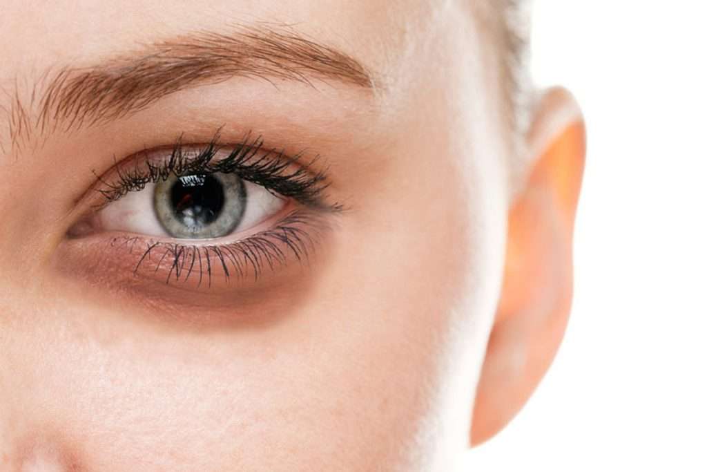 پف زیر چشم چگونه درمان می شود؟