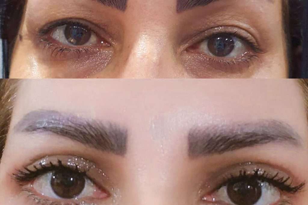 بهترین سن برای عمل بلفاروپلاستی 
