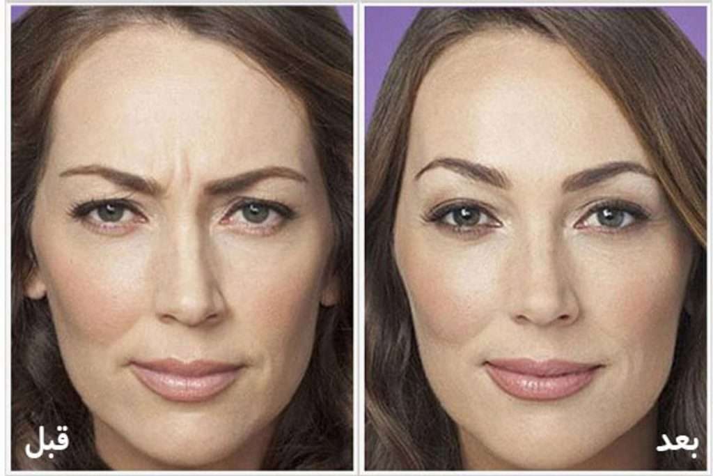 بعد از تزریق بوتاکس پیشانی و ابرو 