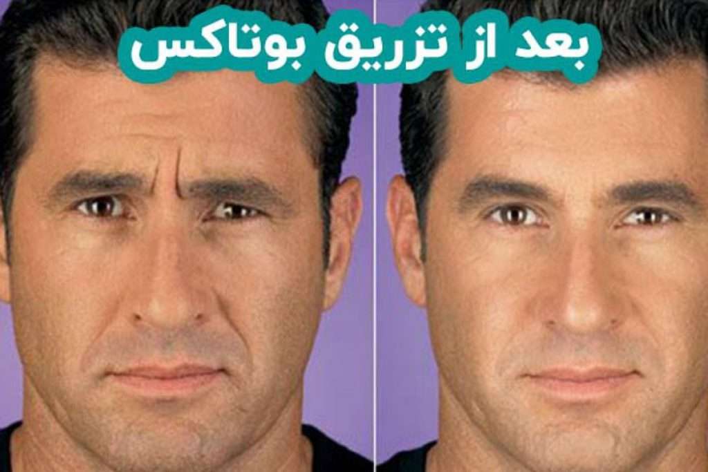 قبل و بعد بوتاکس آقایی را نشان داده است