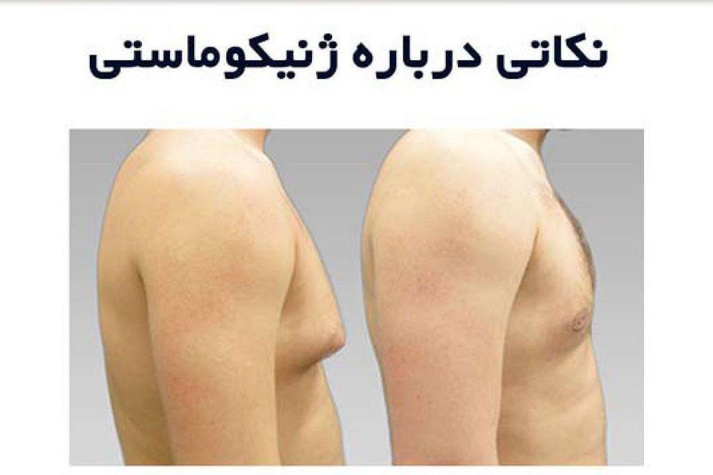 ژنیکوماستی و نکاتی درباره آن