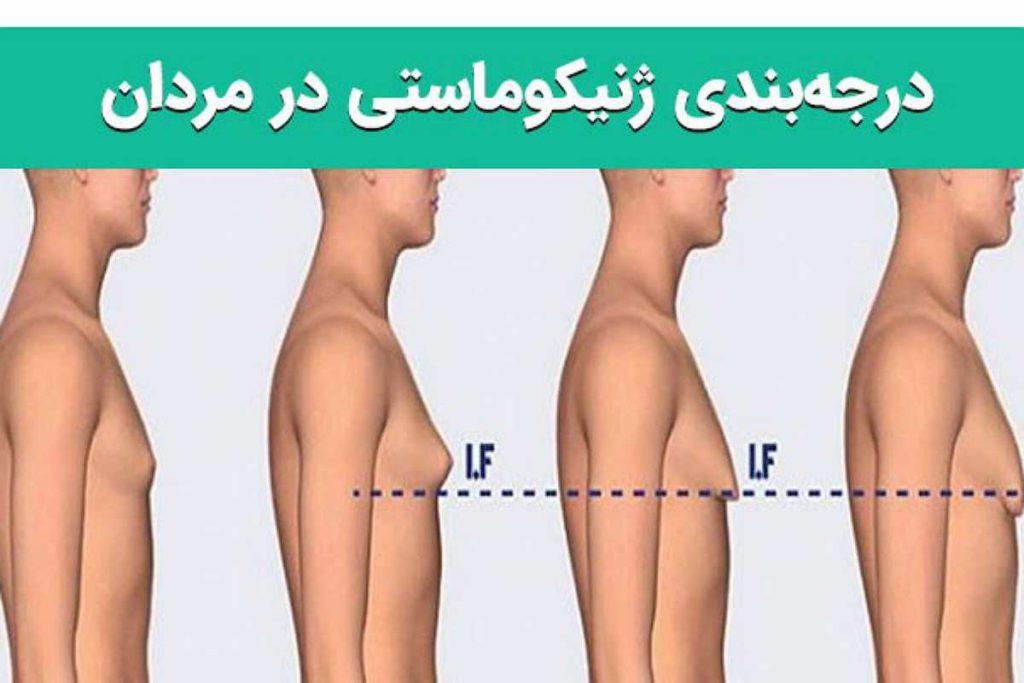 ژنیکوماستی و درجه بندی آن