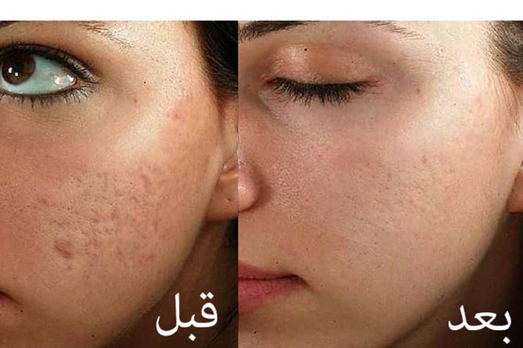 عکس قبل و بعد مزونیدلینگ فردی را نشان داده است 