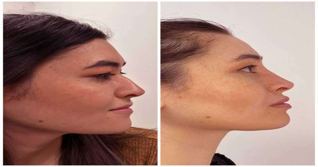 فیلر بینی-https://dermatologyclinic.ir