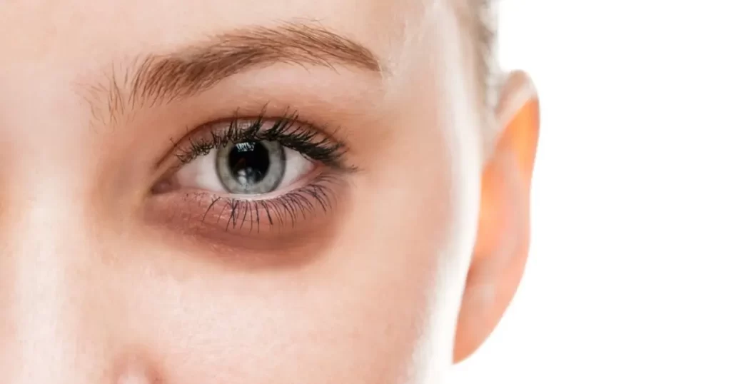 تأثیر کمبود ویتامین ها بر پف زیر چشم (بررسی 6 ویتامین)