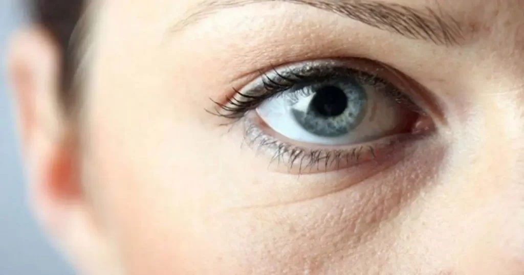 علائم و مراحل درمان پف زیر چشم (10 علامت رایج این بیماری)
