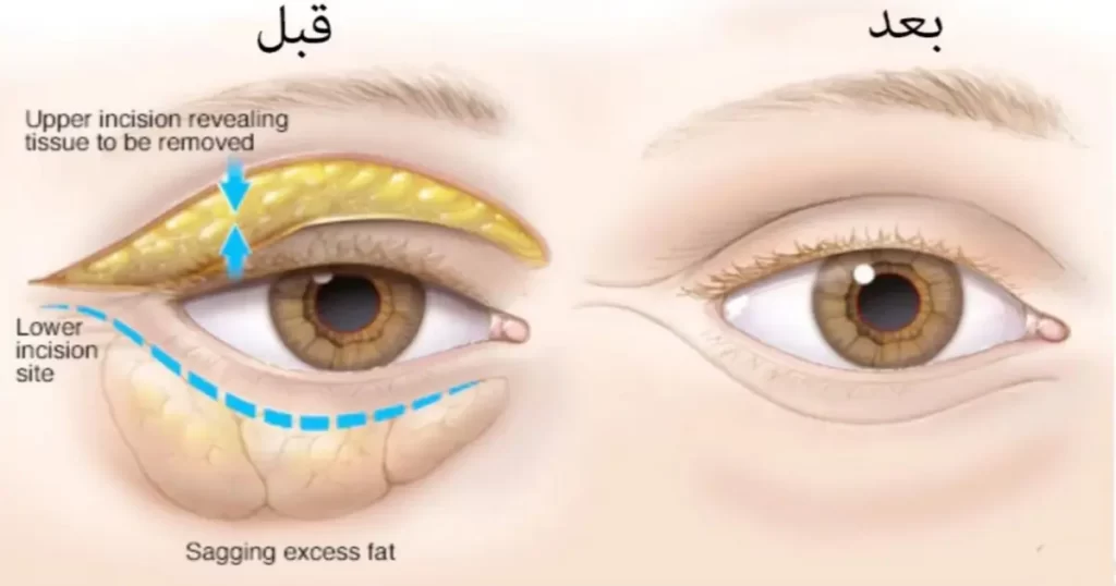 اطلاعات بیشتر درباره ی بهترین دکتر برای درمان پف زیر چشم