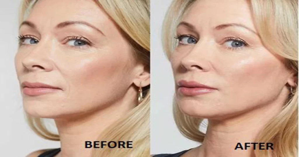 عوارض جتنبی فیلرهای صورت-https://dermatologyclinic.ir