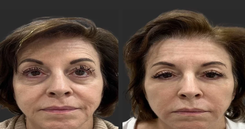 ماندگاری پرکننده های زیر چشم چقدر است؟-https://dermatologyclinic.ir
