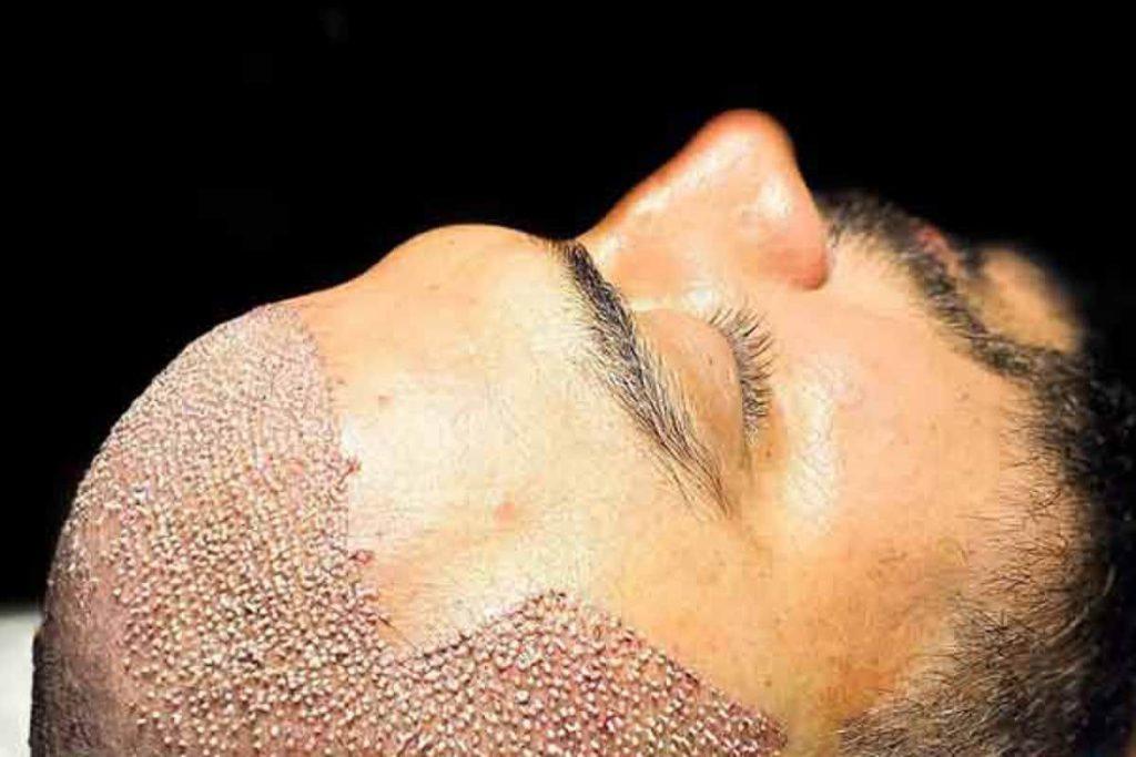 عکس پس از انجام کاشت مو در کلینیک ویستان
