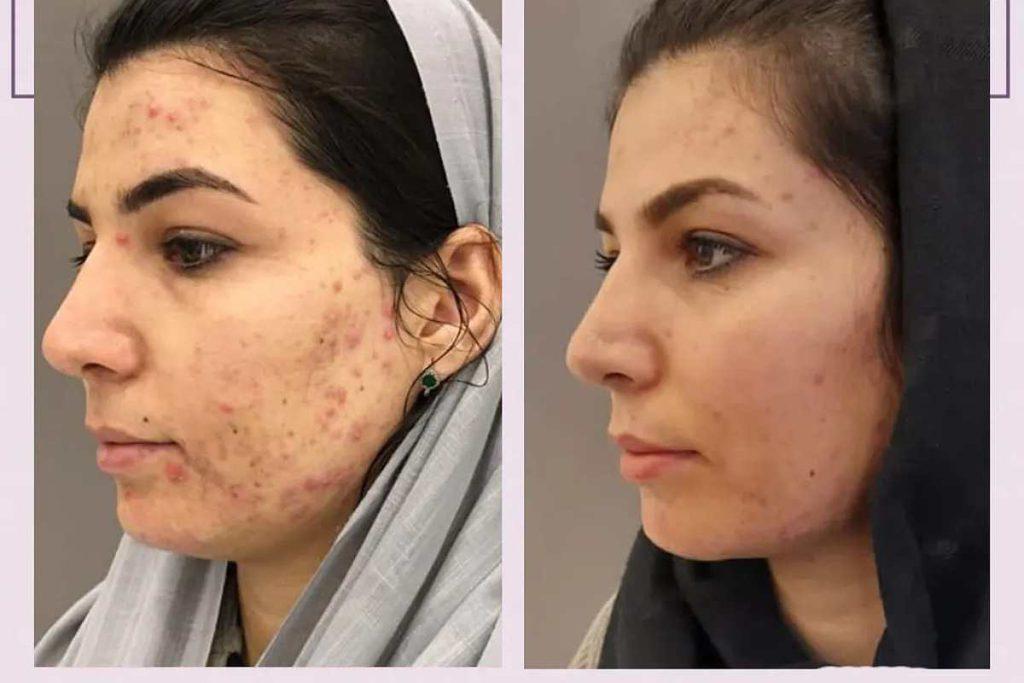 لیزر CO2 فرکشنال