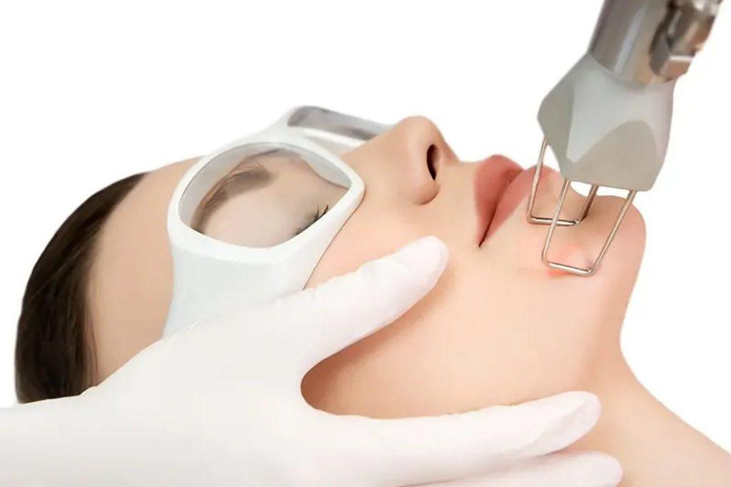 لیزر CO2 فرکشنال