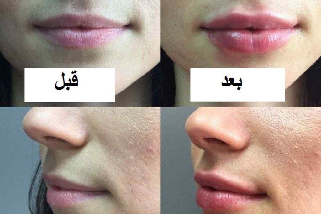 مدل های تزریق ژل لب و قبل و بعد تزریق