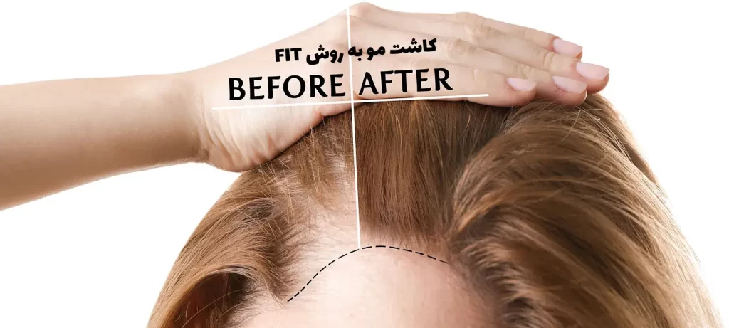 کاشت مو به روش fit 
