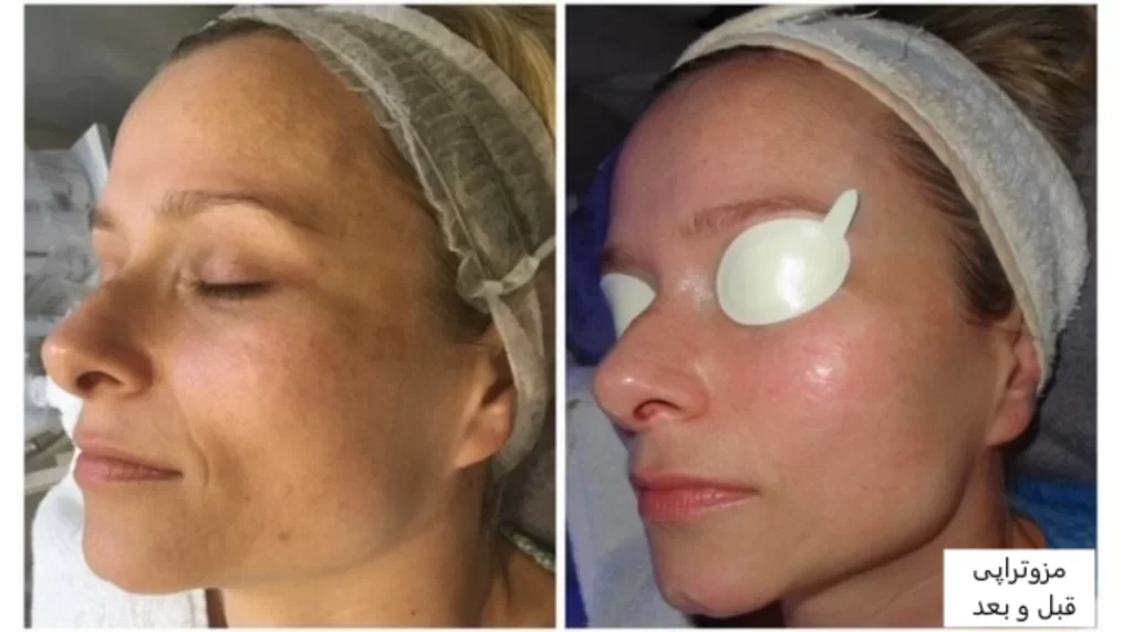 قبل و بعد از مزوتراپی پوست صورت