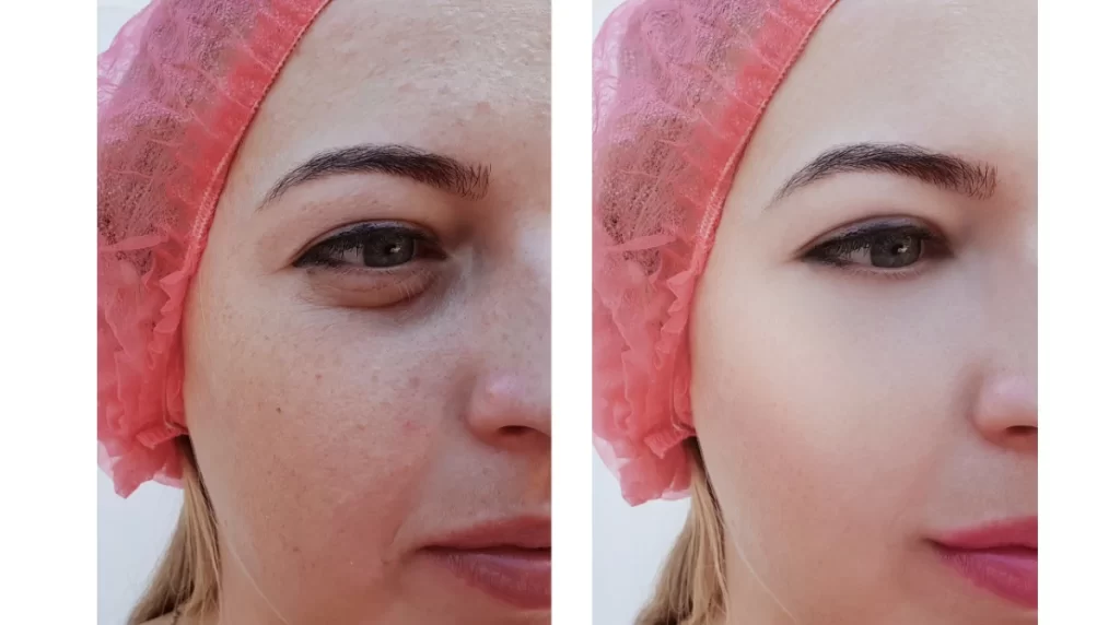 قبل و بعد از مزوتراپی صورت