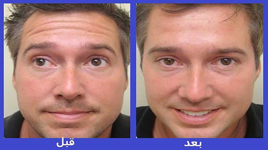 تصویر قبل و بعد از تزریق بوتاکس صورت در مردان