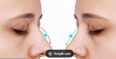 تزریق ژل و بوتاکس به بینی