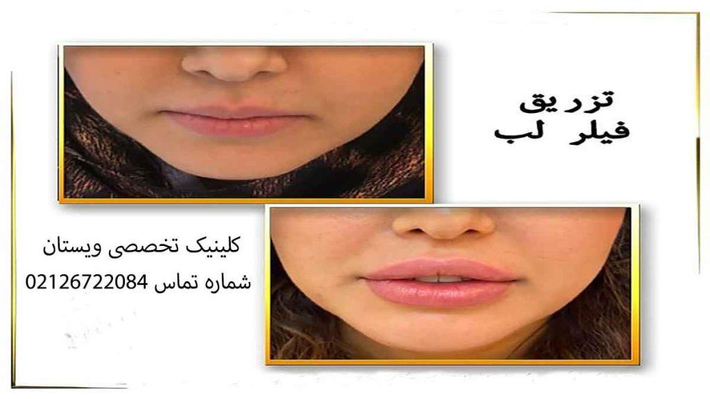 کلینیک تخصصی تزربق فیلر لب در غرب تهران