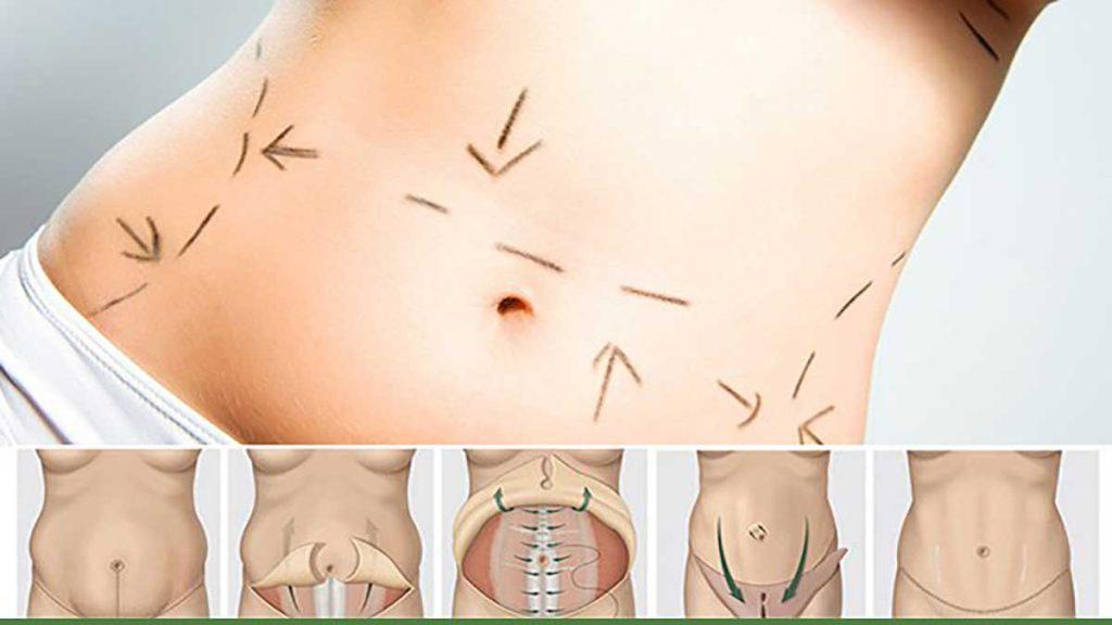 هایفوتراپی شکم و پهلو کوچک کردن شکم با هایفوتراپی