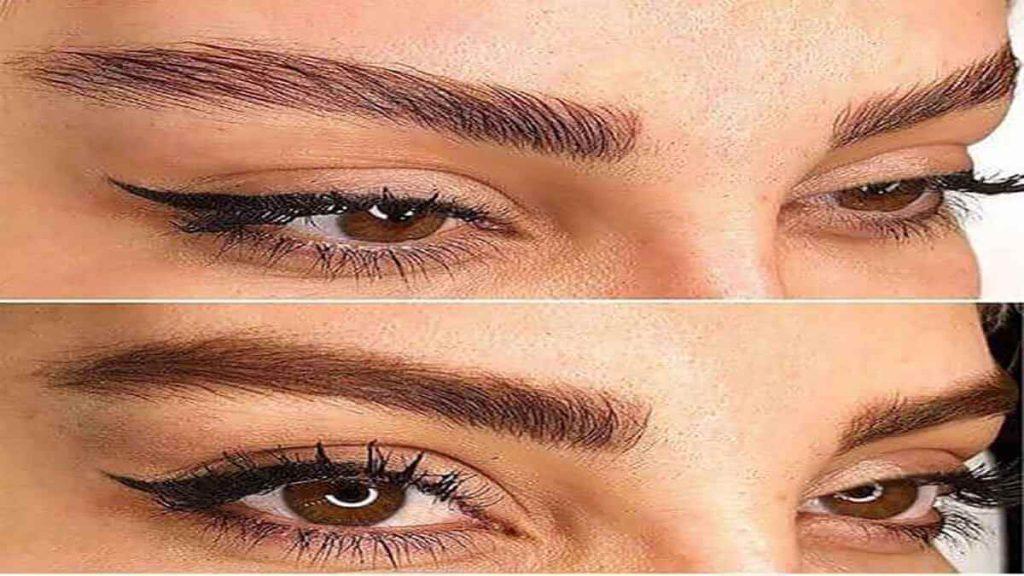 تزریق بوتاکس چشم گربه ای