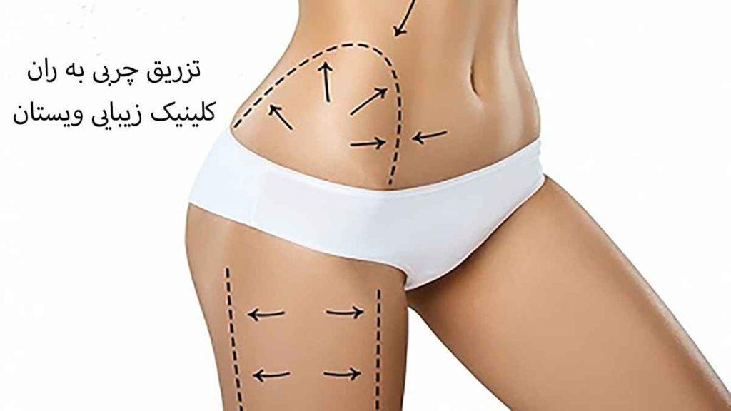تزریق چربی به باسن و ران