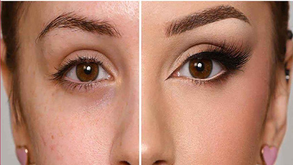 تغییر حالت چشم با تزریق بوتاکس