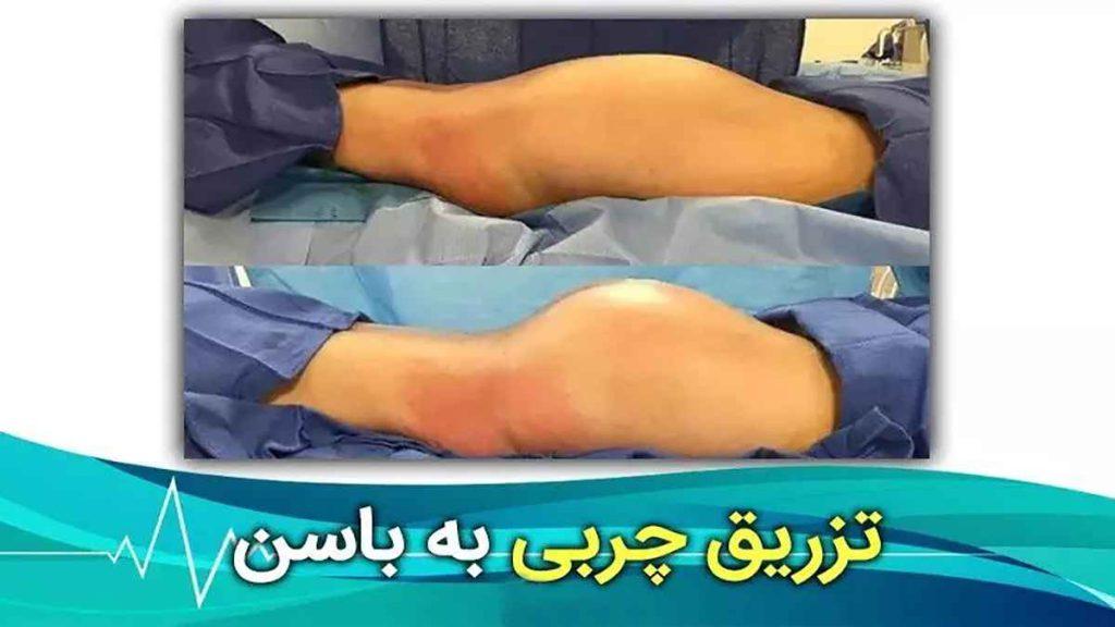 تزریق چربی به باسن