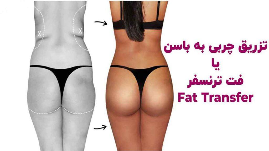 تزریق باسن به چربی