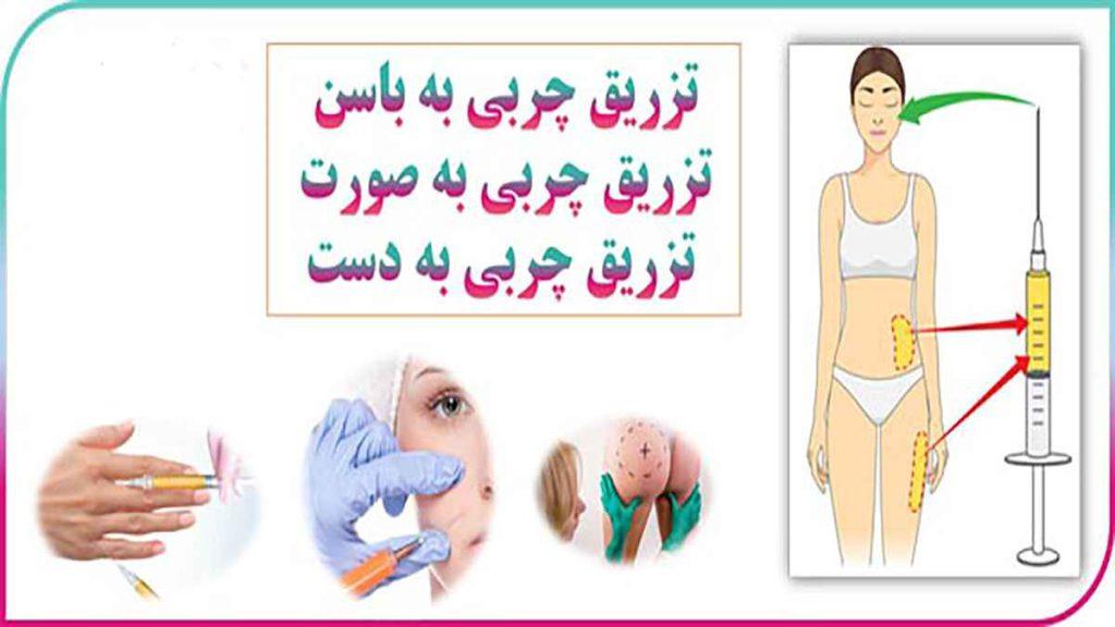 تزریق چربی به باسن