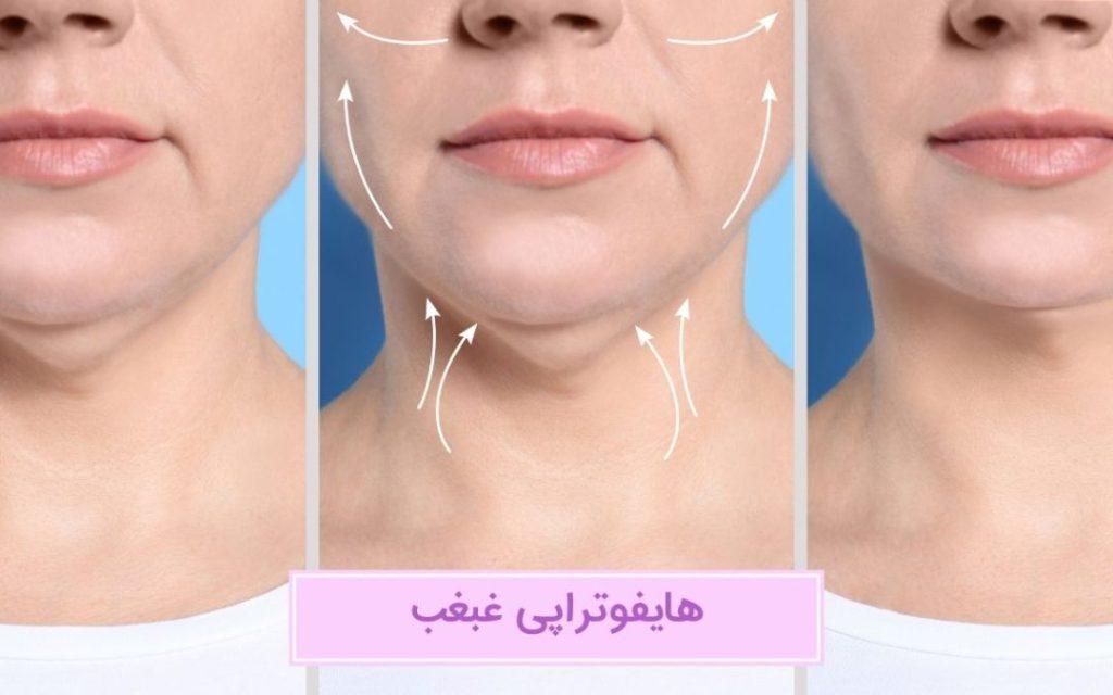 هایفوتراپی غبغب