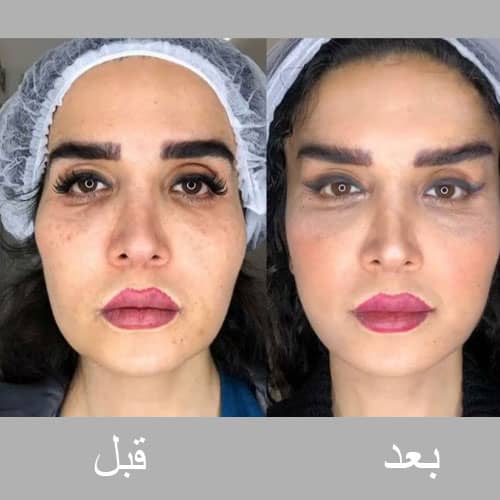 بوتاکس چشم گربه ای قبل و بعد