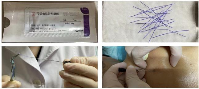 نخ امبدینگ