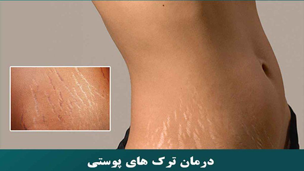 درمان انواع ترک پوستی ترک پوستی لاغری