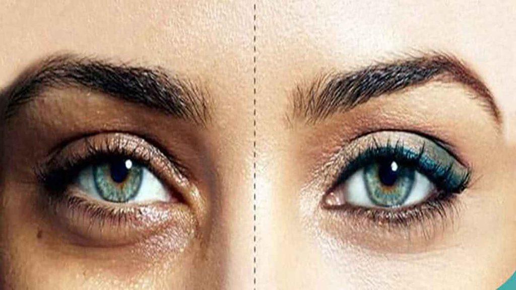 تاثیر مزوتراپی تاثیر مزوتراپی در رفع چین و چروک