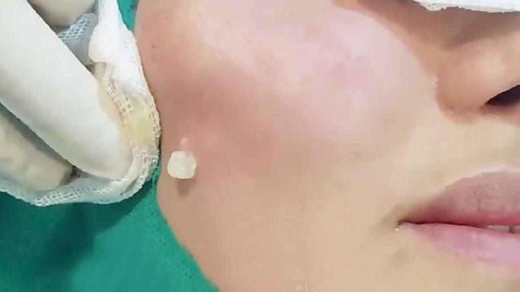 بهترین کلینیک تخلیه ژل لب