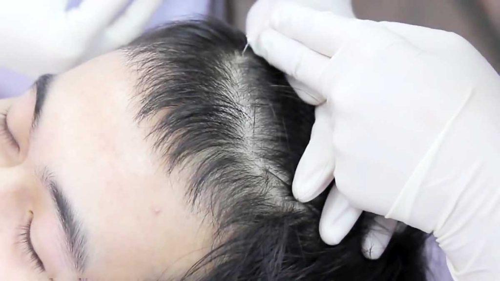 مزوتراپی مو برای مردان