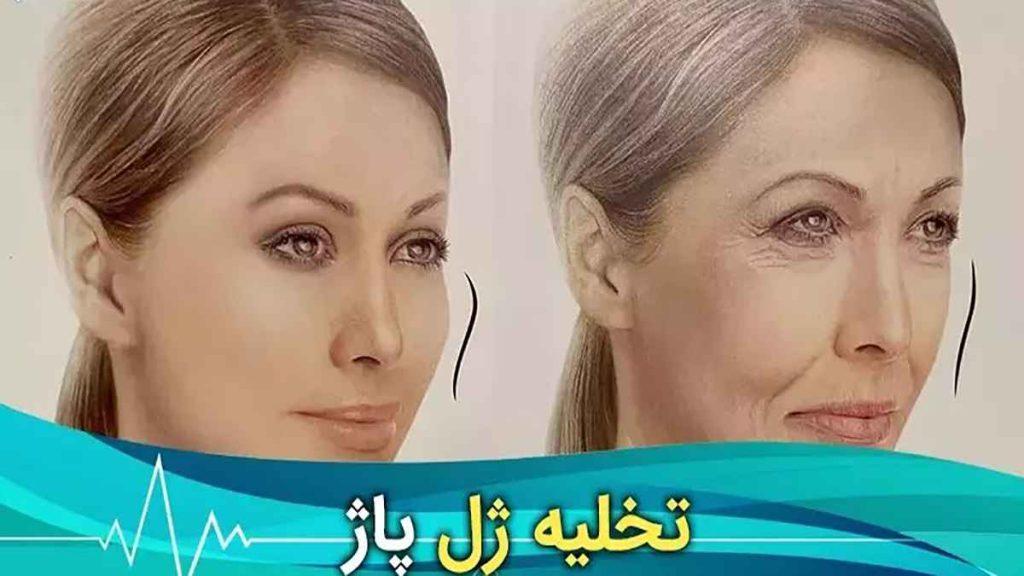 عوارض تخلیه ژل