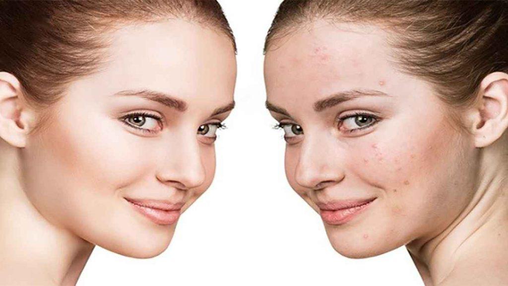 تزریق مزوتراپی صورت