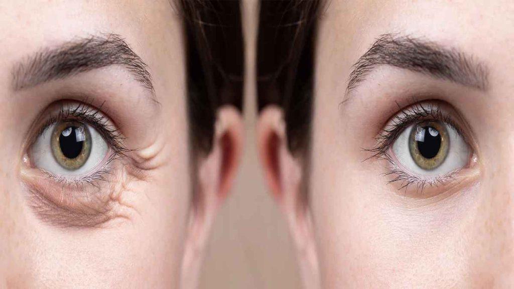 عوارض مزوتراپی عوارض مزوتراپی