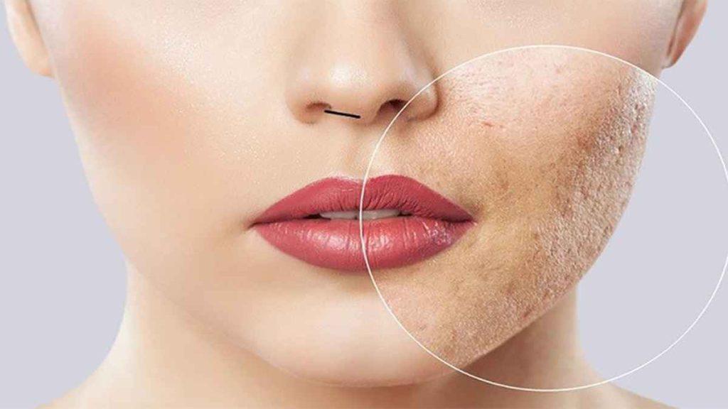 مراقبت قبل از مزوتراپی
